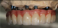 Dental Implant Lab ï¼ŒMYY Dental Lab