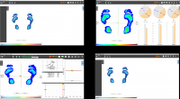 Plantar Pressure Gait Analyzer